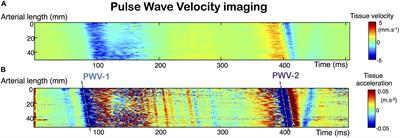 Carotid Stiffness Assessment With Ultrafast Ultrasound Imaging in Case of Bicuspid Aortic Valve